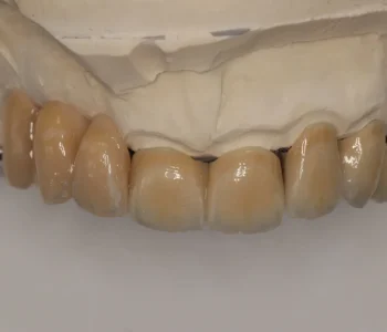 Implantatgetragene Brücke für den Oberkiefer